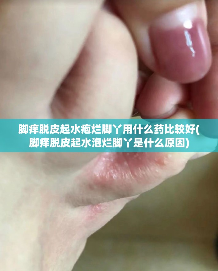 脚痒脱皮起水疱烂脚丫用什么药比较好(脚痒脱皮起水泡烂脚丫是什么原因)