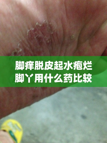 脚痒脱皮起水疱烂脚丫用什么药比较好(脚痒脱皮起水泡烂脚丫是什么原因)