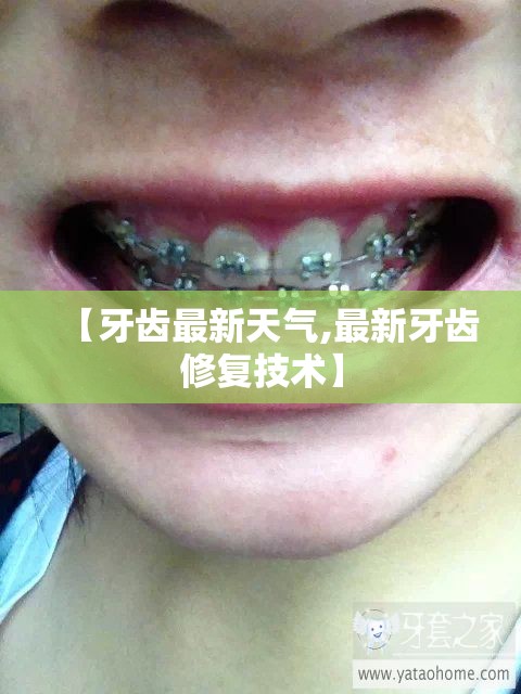 【牙齿最新天气,最新牙齿修复技术】 【牙齿最新天气,最新牙齿修复技术】